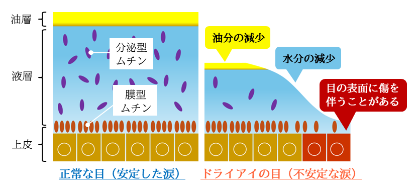 ドライアイとは