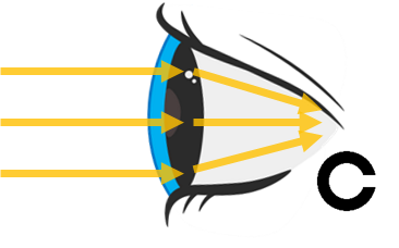 ドライアイの症状