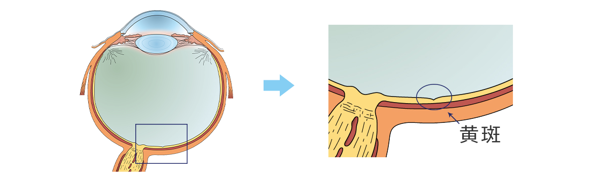 黄斑上膜とは