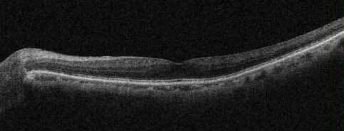 正常な黄斑の断層写真