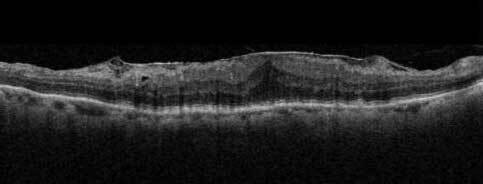 黄斑上膜ができ、黄斑にしわができた断層写真