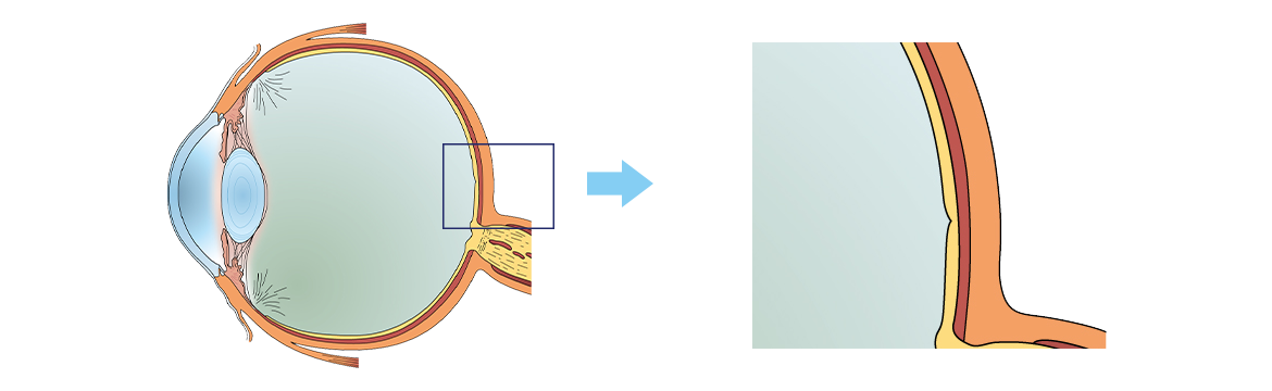 加齢黄斑変性の基礎知識