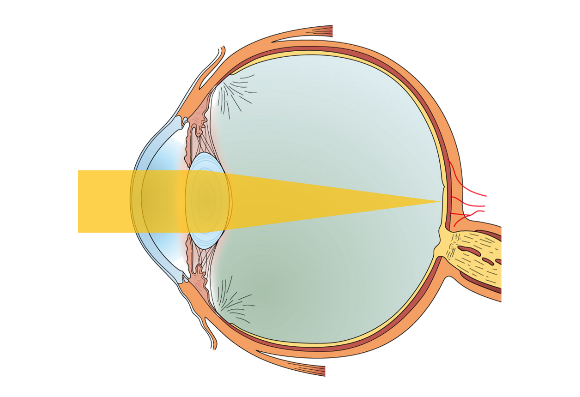 白内障のイメージ