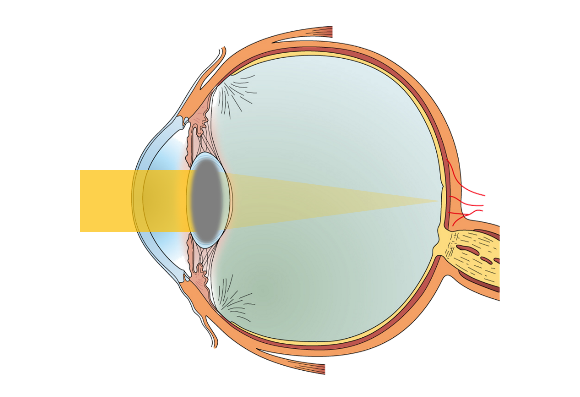 白内障のイメージ