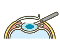 4．水晶体前嚢の切開