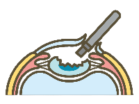 5．水晶体の中身を吸引