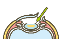 6．眼内レンズを挿入し固定