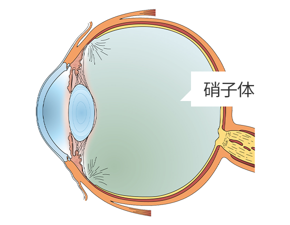 生理的な飛蚊症の原因